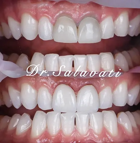 Before and after smile transformation showing gap closure between upper front teeth in Beverly Hills.