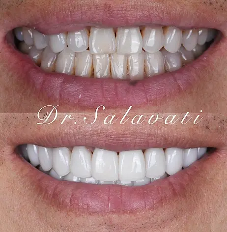 Before and after teeth whitening transformation showing whiter, brighter smile results.